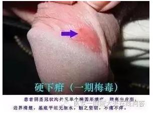 男性如何判断自己有没有性疾病呢
